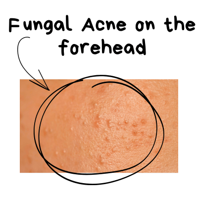 Image showing fungal acne on forehead